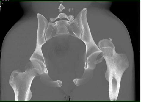 Left Hip Fracture With Dislocation With 3d Mapping Trauma Case