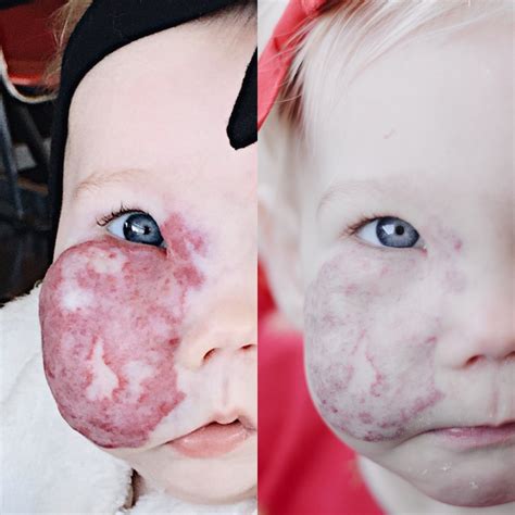 Charlies Hemangioma One Year Later