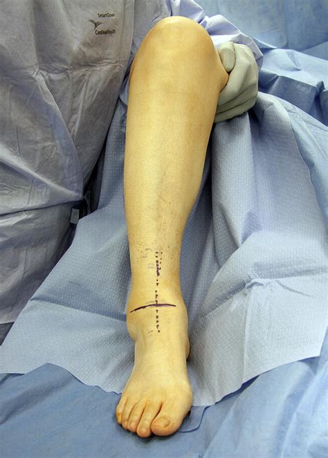 Supramalleolar Osteotomy For Realignment Of The Ankle Joint Clinics