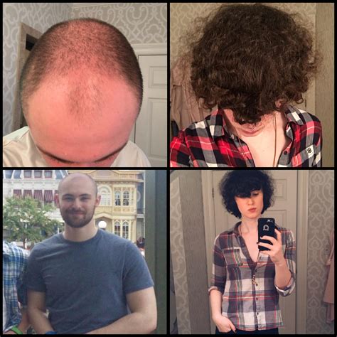 A Quick Before And After To Show The Potential For Hair Regrowth On