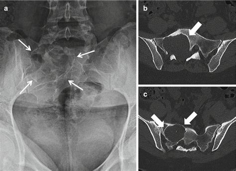 Imaging Of Sacral Tumors And Tumor Simulators Experience Of The Mayo