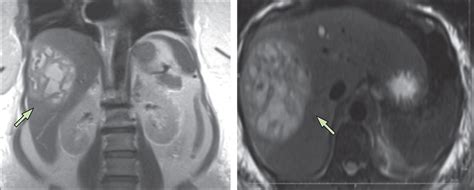 Pyogenic Liver Abscess Caused By Streptococcus Mitis The Lancet