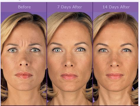Botox Westerville Oh Wrinkle Relaxers Dysport Westerville Oh
