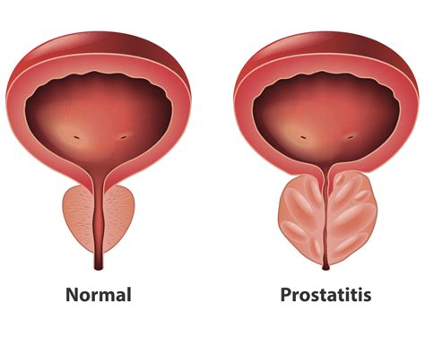 Prostatitis Prostate Infection Causes Symptoms And Treatment