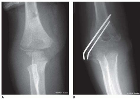 Lateral Epicondyle Fracture Adults Figure From A Rare Combination