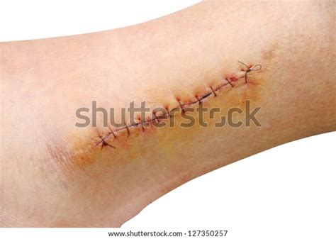 Stitches Leg Ankle Stock Photo Edit Now 127350257