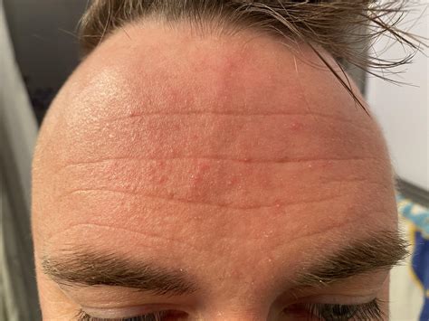 Skin Concerns My Forehead Constantly Looks Like This What Can I Do