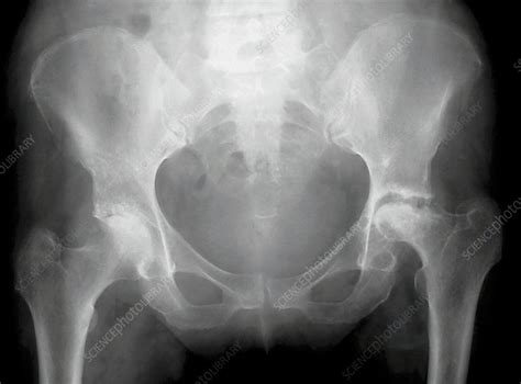 Rheumatoid Arthritis Of The Hip X Ray Stock Image C0095373