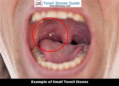 Best Tonsil Stones Images And Videos