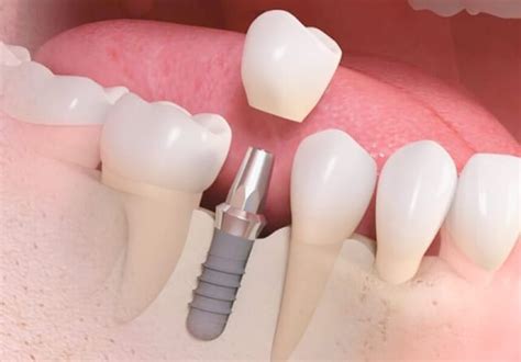 Qu Es Mejor Un Puente O Un Implante Dental Implantes Dentales My Xxx