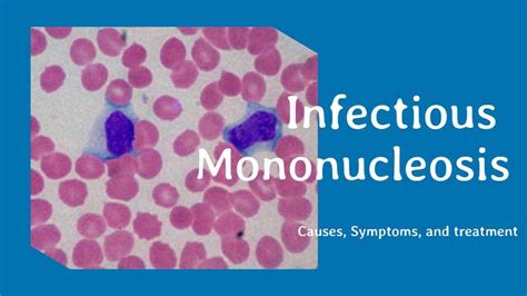 Infectious Mononucleosis 6 Causes Symptoms Treatment And Home