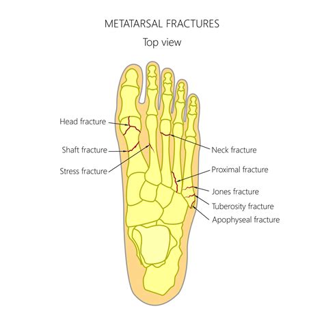 5th Metatarsal Anatomy