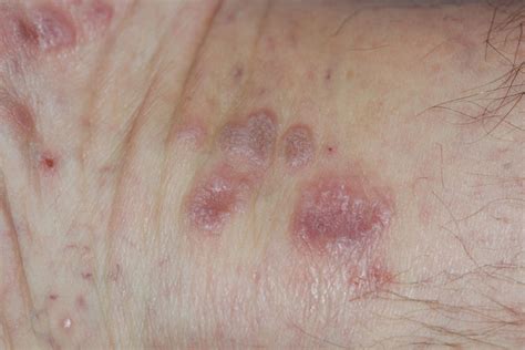 Lichen Planus Pictures And Clinical Information