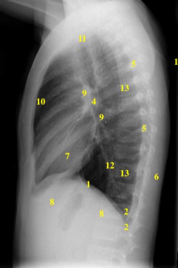 Approach To The Chest X Ray Cxr Undergraduate Diagnostic Imaging