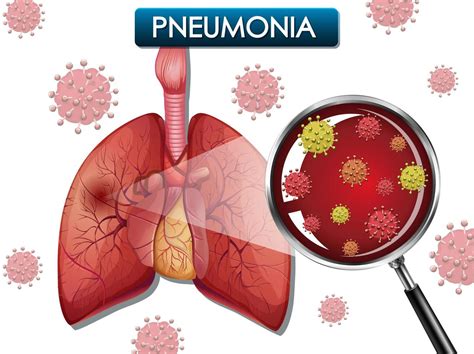 Pneumonia Poster With Lungs And Virus Cells Vector Art At Vecteezy