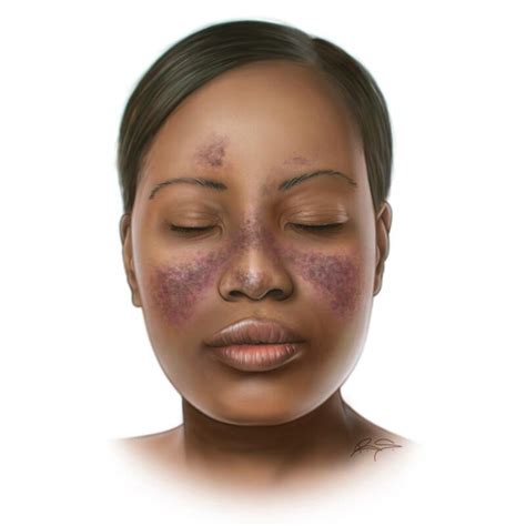 Everything You Need To Know About Systemic Lupus Erythematosus