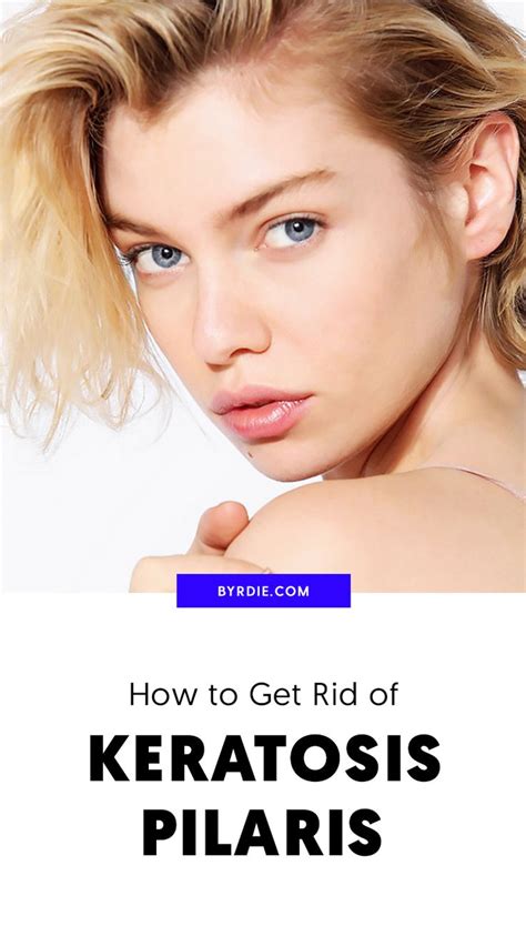 Keratosis Pilaris What It Is And How To Treat It Skin Care Order