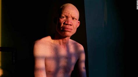 Albino Activist Josephat Torner Fights Witchcraft Killings Cnn