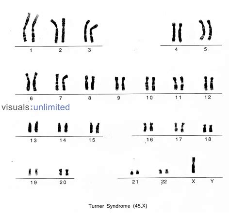 Karyotype Of Female Turner Syndrome Visuals Unlimited