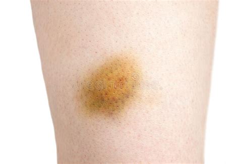 Closeup Bruise Wounded Woman Leg Skin Stock Photos Free And Royalty