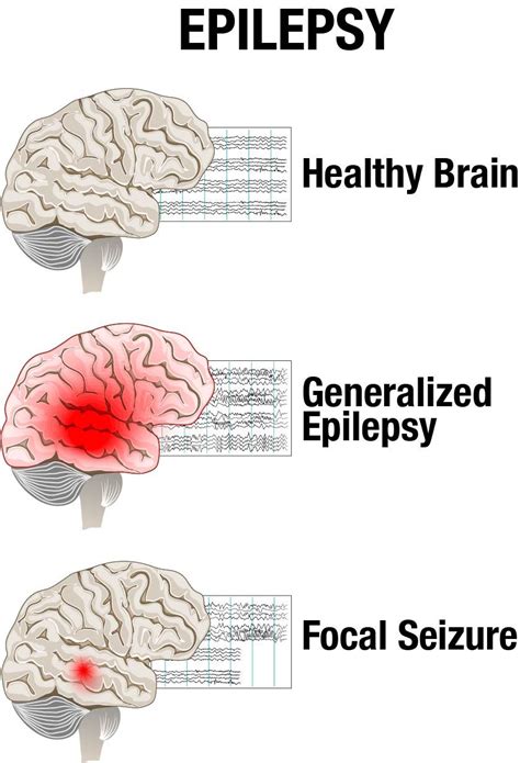 Epilepsy Epilepsy Neurological Disorders Generalized Epilepsy