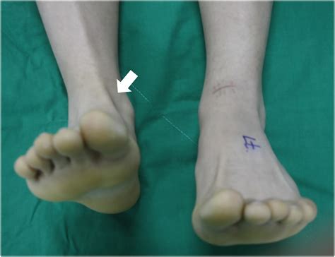 Reconstruction Of Chronic Tibialis Anterior Tendon Ruptures Using A Free Anterior Half Of A