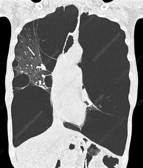 Emphysema Lung Disease Ct Scan Stock Image C0486080 Science