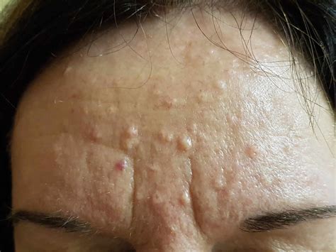 Sebaceous Hyperplasia Causes Signs Symptoms Diagnosis And Treatment