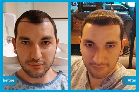 Fue Hair Transplant In Turkey Antalya Aesthetic Travel From Euro