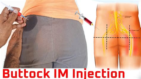 How To Give An Intermuscular Im Injection In Gluteal Muscle At Home Buttock Injection