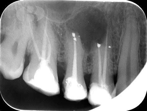 Quiste Radicular Desarrollado Por Un Segundo Premolar Superior