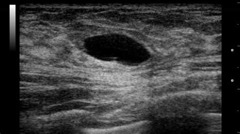 Epidermoid Cyst Ultrasound