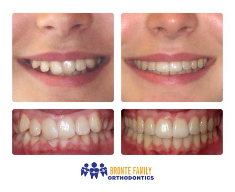 Invisalign Crooked Teeth Before And After Teethwalls