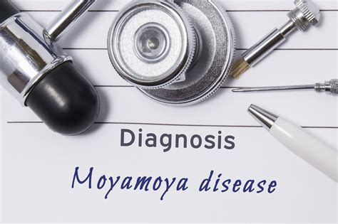 Choroba Moyamoya Przyczyny Objawy Leczenie Poradnikzdrowiepl