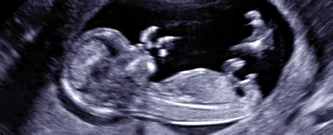 Wann ist die überweisung zu einem spezialisten sinnvoll? Ultraschallbilder 12 Ssw Junge - Test 6