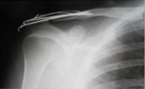 Acromioclavicular Joint Dislocations Treated With Kirschner Wire