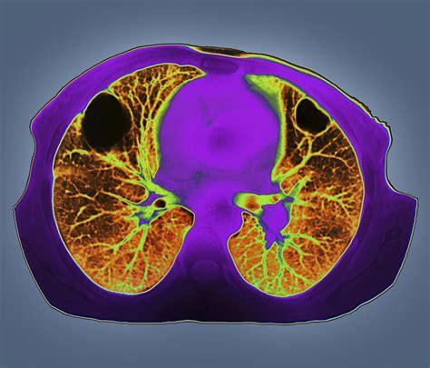 Lung Abscess Ct Scan Photograph By Zephyr