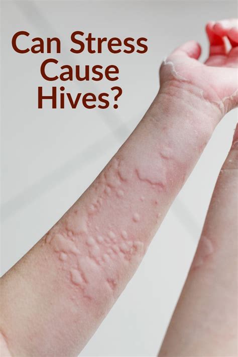 Stress As Related To Hives Pictures