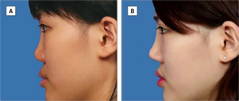 Saddle Nose Correction Jama Facial Plastic Surgery The Jama Network