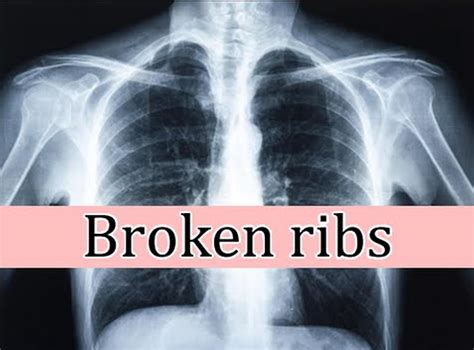 Broken Rib Causes Signs Symptoms Recovery Time And Treatment