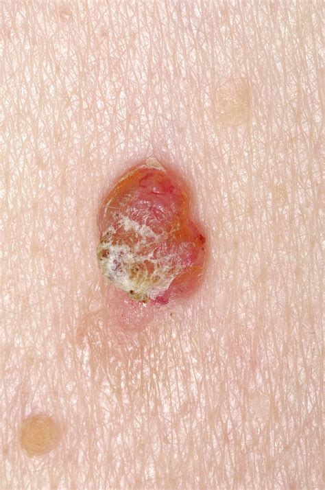 Basal Cell Carcinoma Photograph By Dr P Marazziscience Photo Library