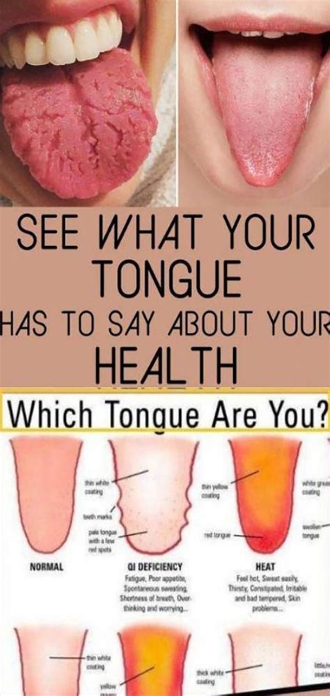 What Your Tongue Is Trying To Tell You About Your Health Tongue Health Health Natural Medicine