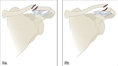 Clavicle Collarbone Fracture Anesthesia Key