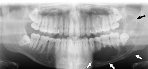 Focal Benign Disorders Of The Pediatric Mandible With Radiologic