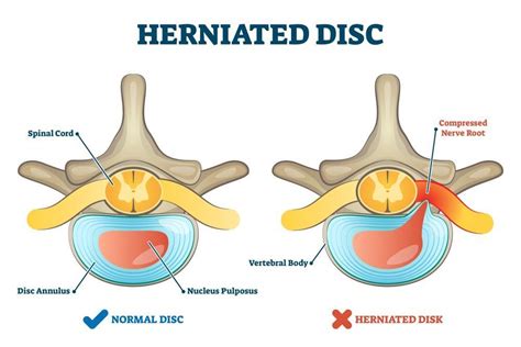Artificial Disc Replacement An Alternative To Spinal Fusion Remi