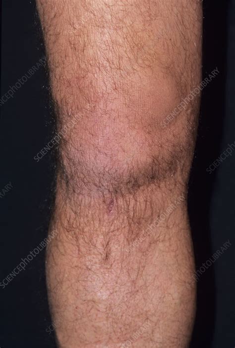 Torn Knee Ligament Stock Image M3301180 Science Photo Library
