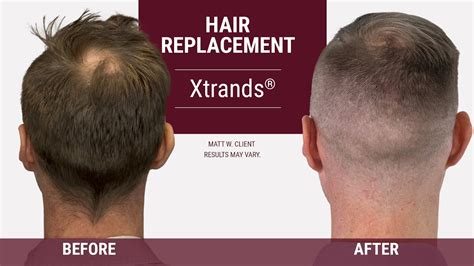 How To Cover A Bald Spot On The Back Of Your Head Hair Replacement