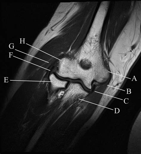 T1 Weighted Coronal Magnetic Resonance Image Of The Right Elbow The Bmj
