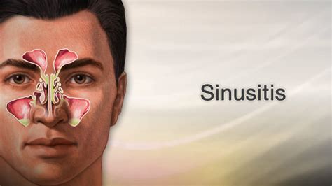 Hie Multimedia Sinusitis In Adults Aftercare