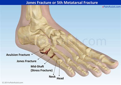 Jones Fracture Or 5th Metatarsal Fracturecausessymptomstreatment